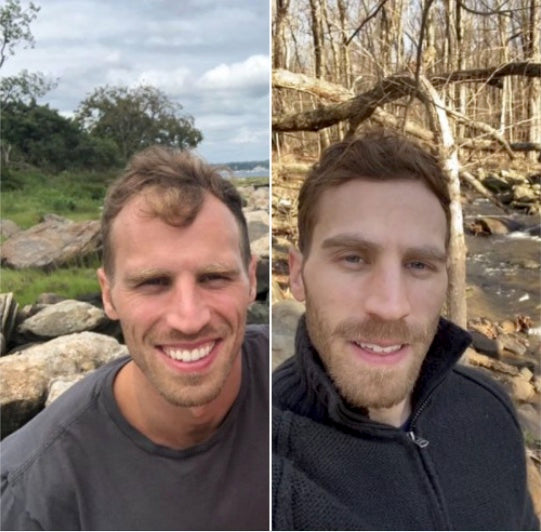 Two photographs of Jason showing his personal change in hair density over time